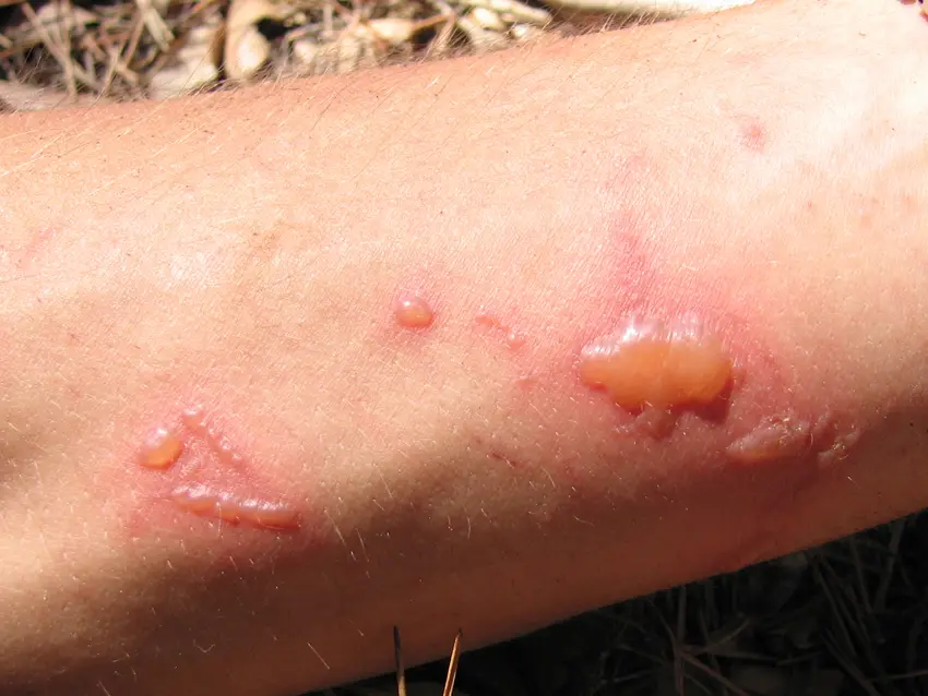 A forearm with reddened skin and fluid-filled blisters in a streaky pattern after contact with rue followed by sunlight